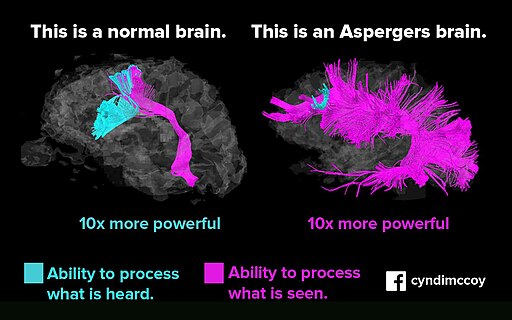 Asperger vs normal brain