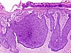 Basal cell carcinoma histopathology (1).jpg