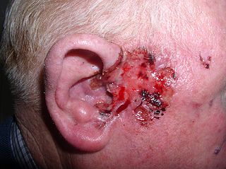 <span class="mw-page-title-main">Basal-cell carcinoma</span> Most common type of skin cancer