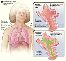Bronchitis.jpg