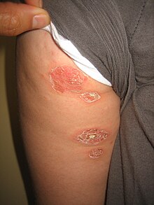 Bullous impetigo on the arm Bullous impetigo2.jpg