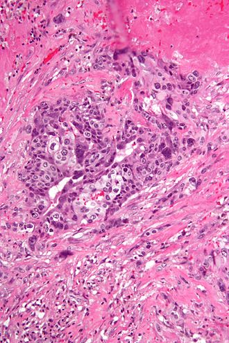 High magnification micrograph of choriocarcinoma. H&E stain. Choriocarcinoma -2- high mag.jpg