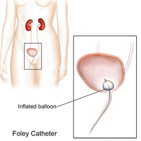 Foley Catheter Illustrasjon