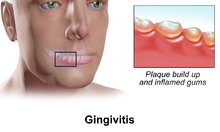 Gingivitis Gingivitis.png