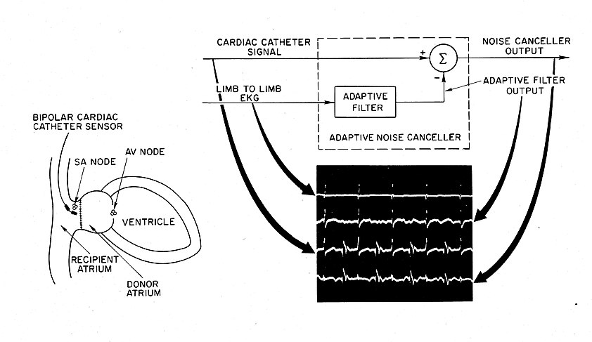 Extracting remnant pacemaker signal from heart transplant ECG Heart transplant ECG Final.jpg