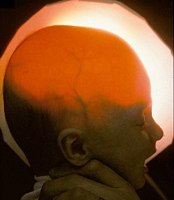 صورة لرضيع مصاب بموه انعدام المخ، حيث يمر الضوء خلال الجمجمة مشيرًا إلى عدم وجود مقدم الدماغ. http://neuropathology-web.org"