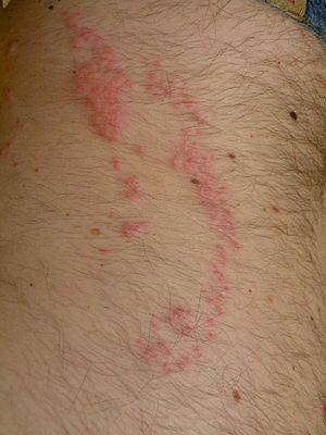 Jellyfish dermatitis case1 abdominal skin back.jpg