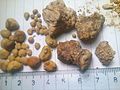 Kidney stones ( renal calculi ), Бубрежни камења 5.jpg