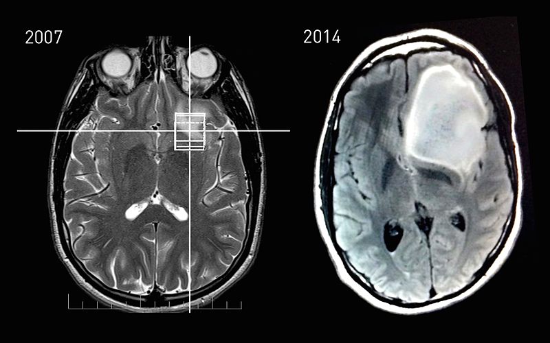 File:MRI Slices - 2007 and 2014 of astrocytoma patient - Steven Keating.jpg