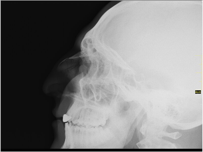 File:Medical X-Ray imaging JWD05 nevit.jpg