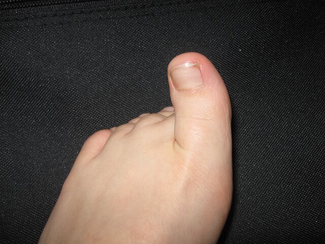 The big toe of a human