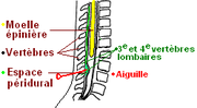 Vignette pour Anesthésie péridurale