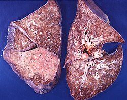 Pneumonia, mixed patterns, lobar and bronchopneumonia (3679096639).jpg