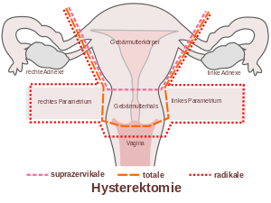 Histerektomi