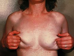 Tinea versicolor due to Malassezia furfur PHIL 2914 lores.jpg