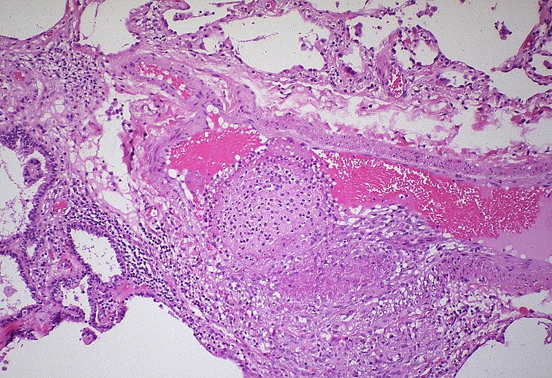 File:Tuberculous granulomatous vasculitis-lung (6544828431).jpg