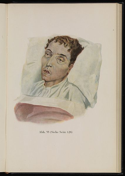 File:Young man suffering from dysentery. Baumgartner, 1929 Wellcome L0074305.jpg