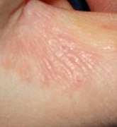 Scabies of the finger