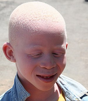 albino african american model