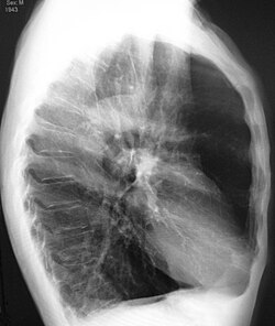 צילום רנטגן של אדם חולה בנפחת עם מאפייני חזה דמוי חבית וסרעפת שטוחה