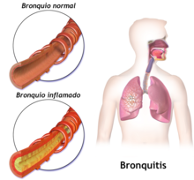 Bronchitis-es.png