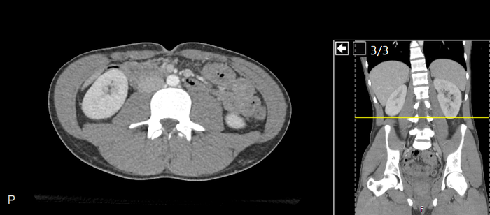 CT of a normal abdomen and pelvis, axial plane 142.png