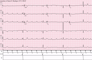 Atrial tachycardia with complete A-V block and resulting junctional escape Complete A-V block with resulting junctional escape.png
