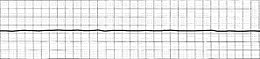 ECG Asystole.jpg