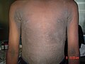 Familial acanthosis nigricans5.jpg