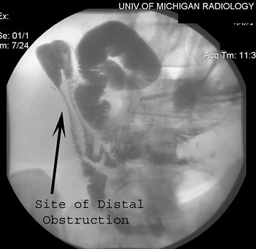 Gardner's syndrome