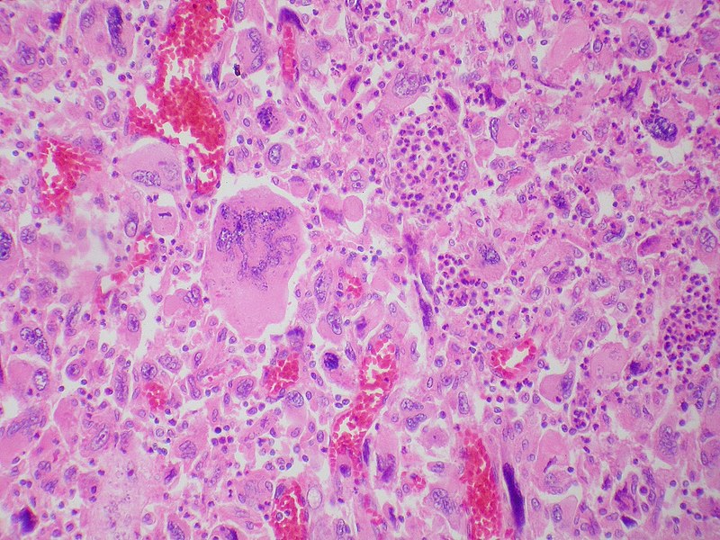 article - Giant-cell carcinoma of the lung