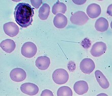 Blood film showing giant platelets - arrows - in a person with ITP (Giemsa stain) Giant platelets in ITP.jpg