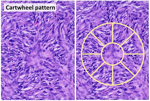 Cartwheel pattern: Center points that radiate cells or connective tissue outward