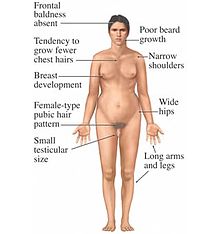 The symptoms of Klinefelter's syndrome in a human male. Klinefelter's syndrome.jpg