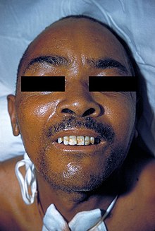 A classical sign of Tetanus, risus sardonicus is a form of facial dystonia producing a fixed smiling or grinning expression. Lock-jaw 2857.jpg