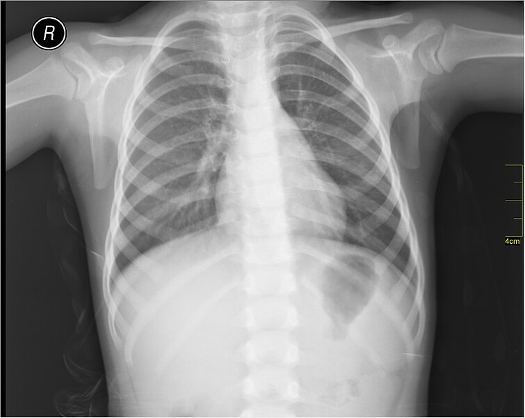 File:Medical X-Ray imaging OLK06 nevit.jpg