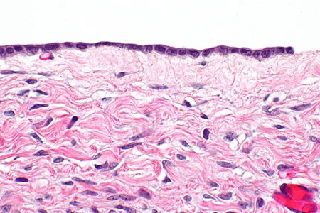 Ovarian serous cystadenoma -- very high mag.jpg