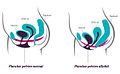 Plancher pelvien féminin affaibli à la suite de l'accouchement.