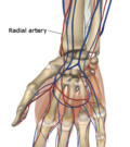 Thumbnail for Radial artery puncture