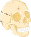 Skull fractures