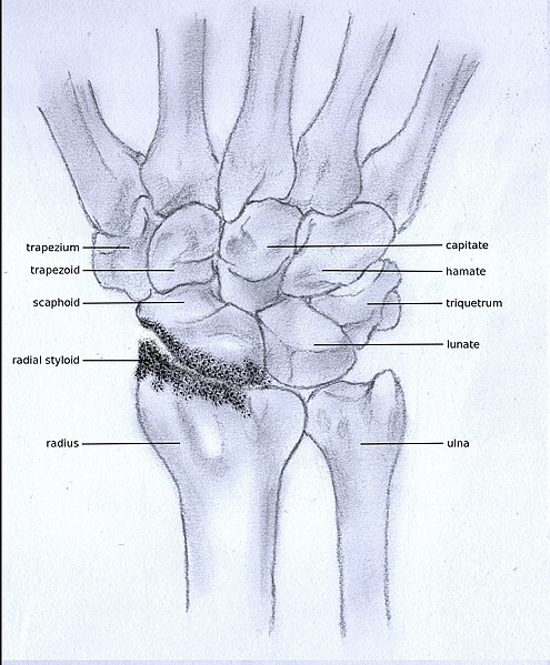 File:Stadium2osteoarthritis.JPG