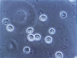Bacteriuria pyuria 4.jpg