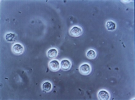 Phase-contrast microscopic image showing many bacteria and white blood cells in the urine. These changes suggest a urinary tract infection.
