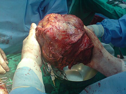 Left lobe liver tumour in a 50-year-old male, operated in King Saud Medical Complex, Riyadh, Saudi Arabia