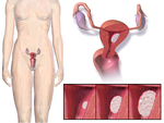 Localização e desenvolvimento do cancro do endométrio