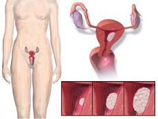 A diagram of the location and development of endometrial cancer