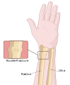 Buckle fracture of the Radius.svg