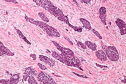 Desmoplastic small round cell tumour - intermed mag.jpg
