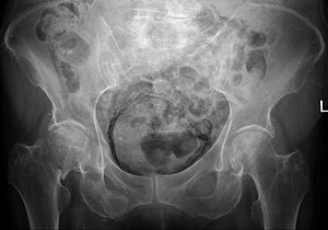 Emphysematous cystitis - X-rax - SHF.jpg