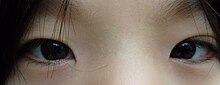 Pseudostrabismus in a Korean child Epicanthic KR07.jpg